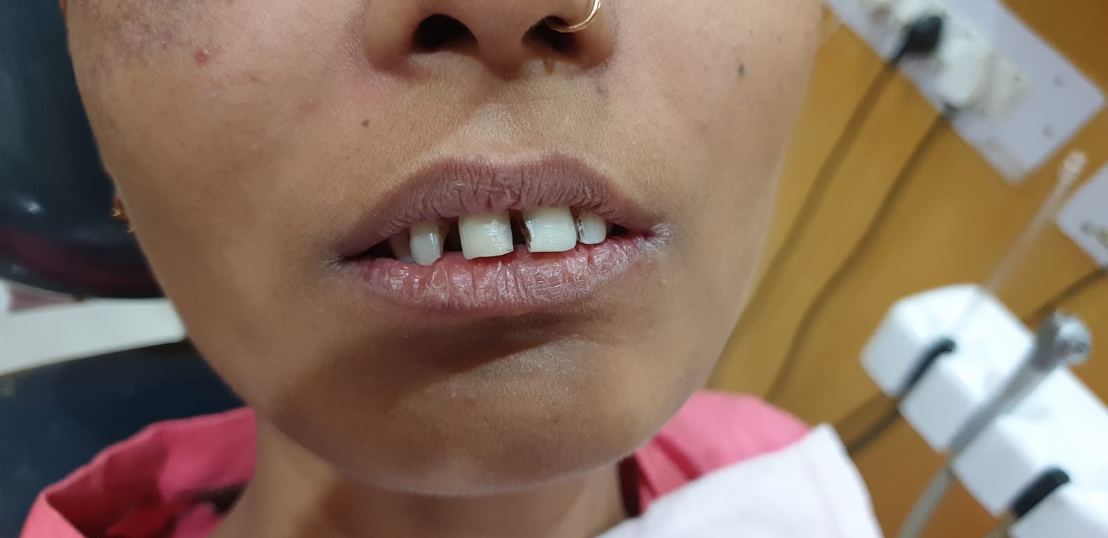 BEFORE TREATMENT